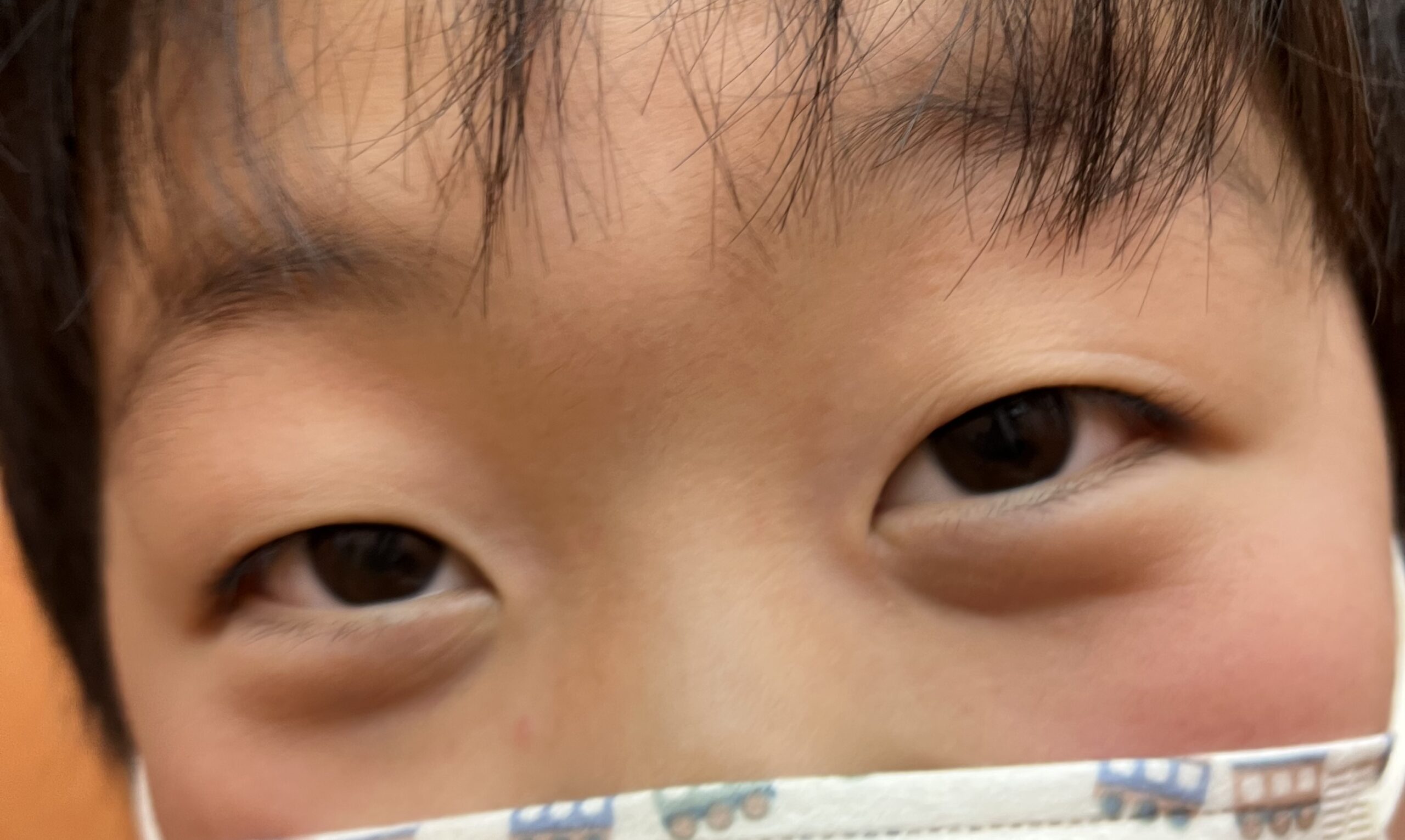 6歳男子の間欠性外斜視の手術から1年経過報告